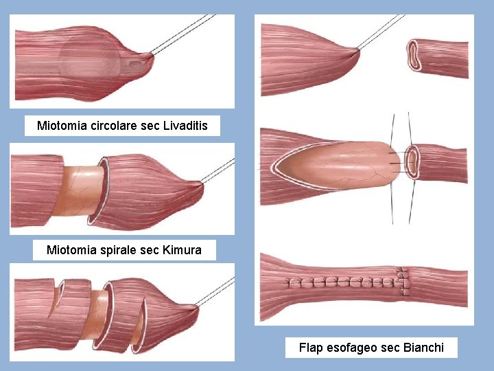 Miotomia circolare sec Livaditis Miotomia spirale sec Kimura Flap esofageo sec Bianchi 