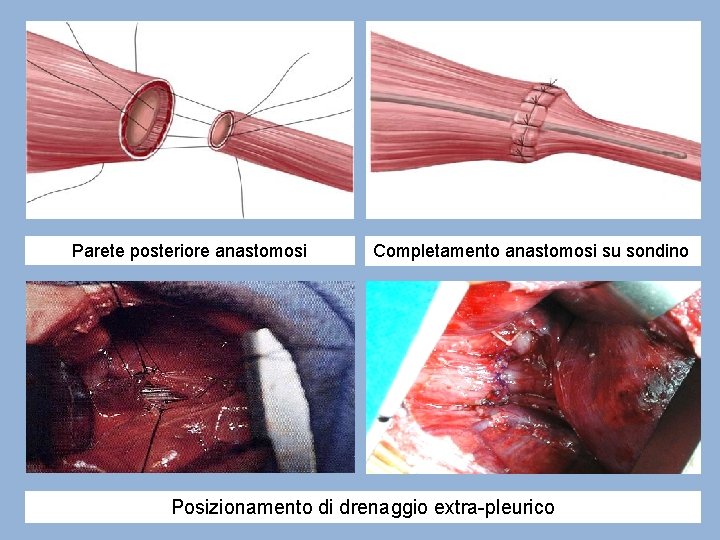 Parete posteriore anastomosi Completamento anastomosi su sondino Posizionamento di drenaggio extra-pleurico 