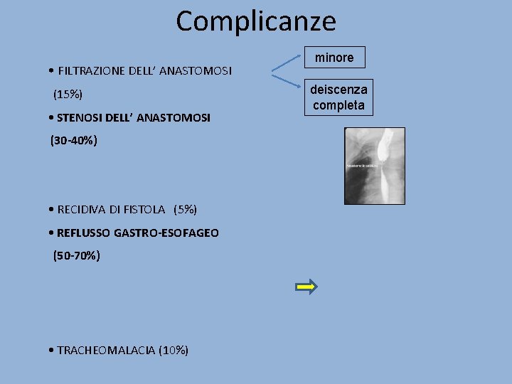 Complicanze • FILTRAZIONE DELL’ ANASTOMOSI (15%) • STENOSI DELL’ ANASTOMOSI minore deiscenza completa (30