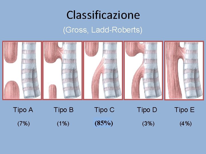 Classificazione (Gross, Ladd-Roberts) Tipo A Tipo B Tipo C Tipo D Tipo E (7%)