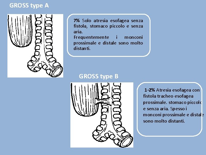 GROSS type A 7% Solo atresia esofagea senza fistola, stomaco piccolo e senza aria.