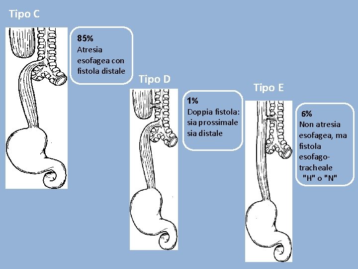 Tipo C 85% Atresia esofagea con fistola distale Tipo D Tipo E 1% Doppia