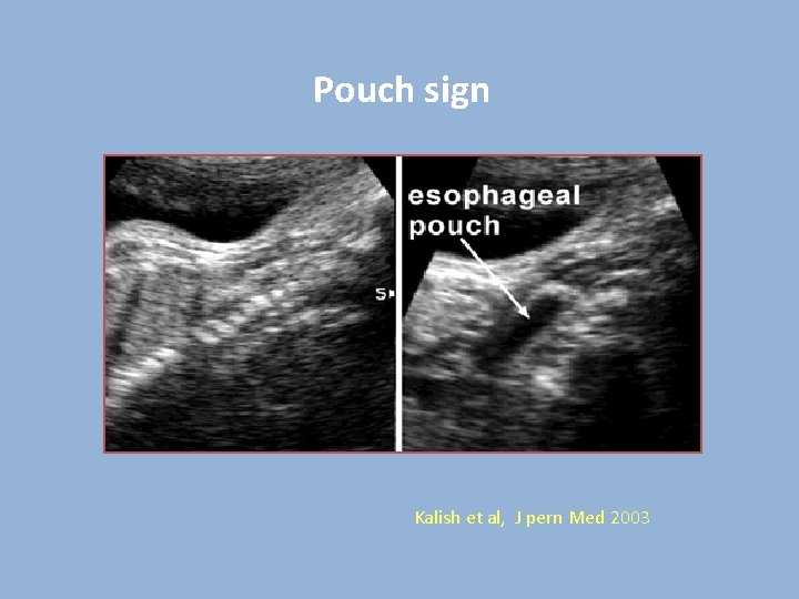 Pouch sign Kalish et al, J pern Med 2003 