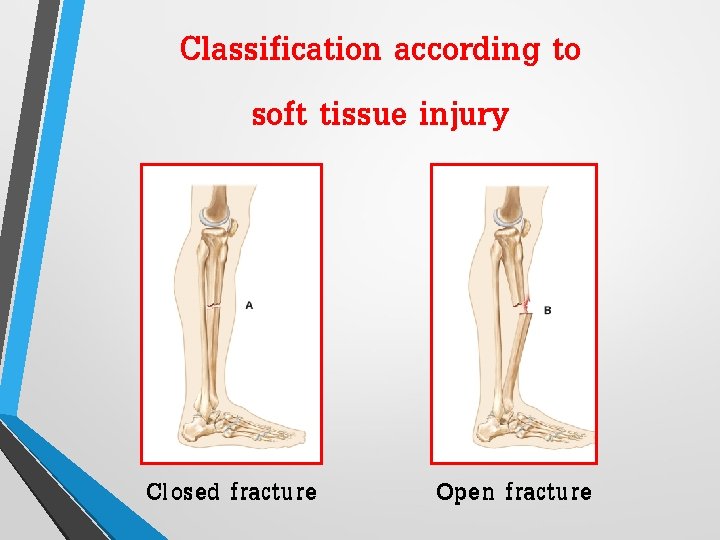 Classification according to soft tissue injury Closed fracture Open fracture 