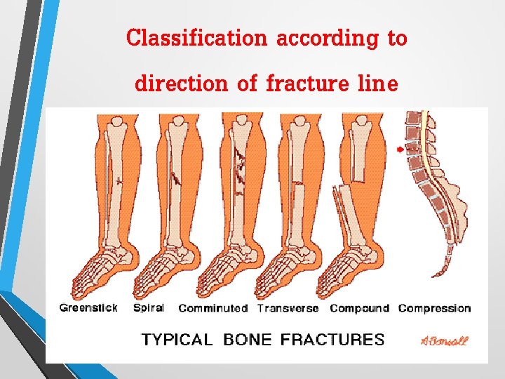 Classification according to direction of fracture line 