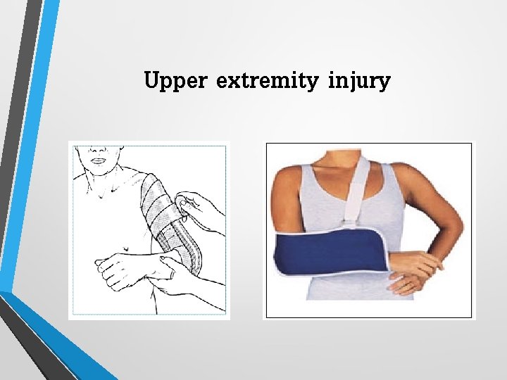 Upper extremity injury 
