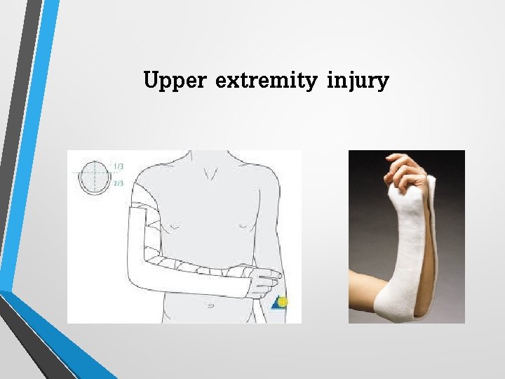 Upper extremity injury 