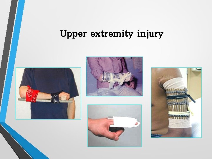 Upper extremity injury 
