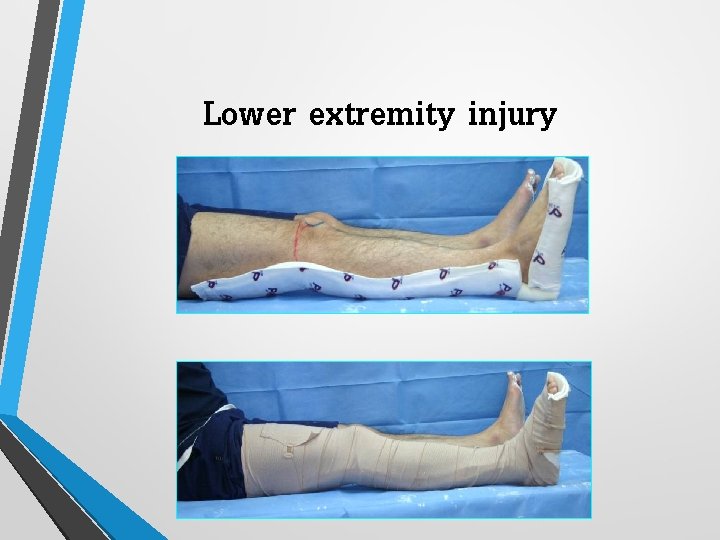 Lower extremity injury 