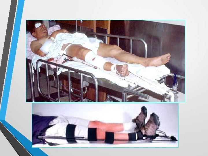 Lower extremity injury 