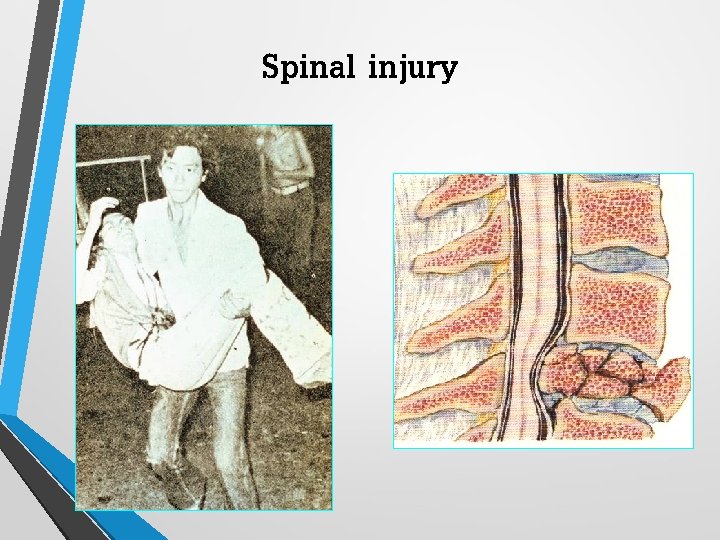 Spinal injury 