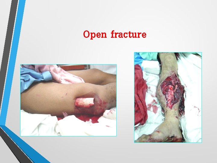 Open fracture 