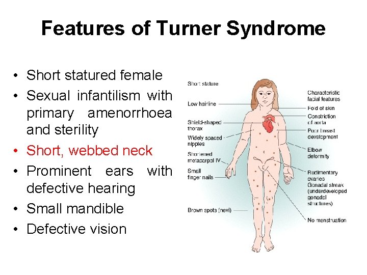 Features of Turner Syndrome • Short statured female • Sexual infantilism with primary amenorrhoea