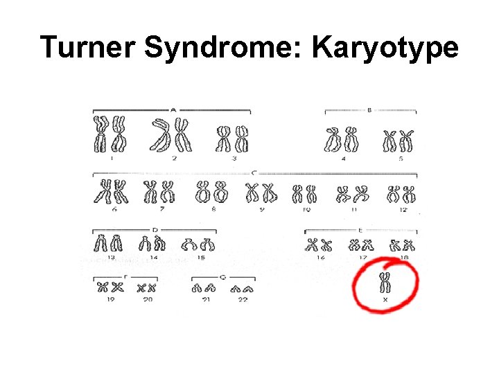 Turner Syndrome: Karyotype 