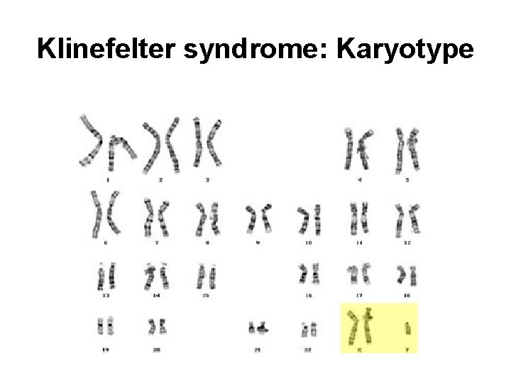 Klinefelter syndrome: Karyotype 