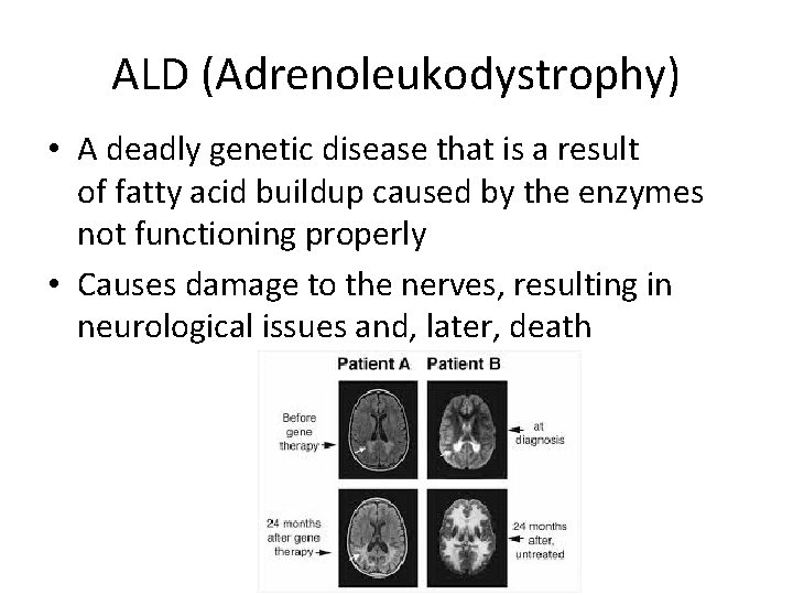 ALD (Adrenoleukodystrophy) • A deadly genetic disease that is a result of fatty acid