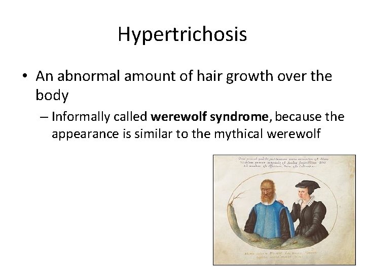 Hypertrichosis • An abnormal amount of hair growth over the body – Informally called Hypertrichosis • An abnormal amount of hair growth over the body – Informally called
