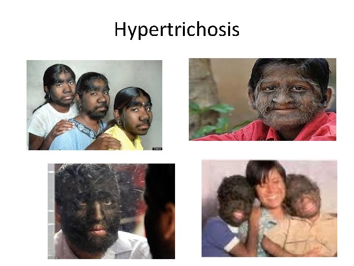 Hypertrichosis 