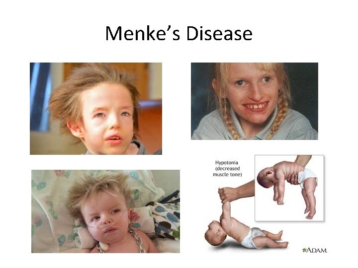 Menke’s Disease Menke’s Disease