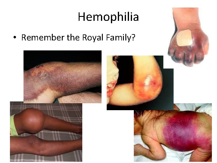 Hemophilia • Remember the Royal Family? Hemophilia • Remember the Royal Family?