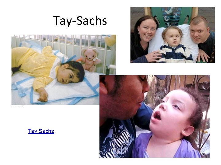 Tay-Sachs Tay Sachs 