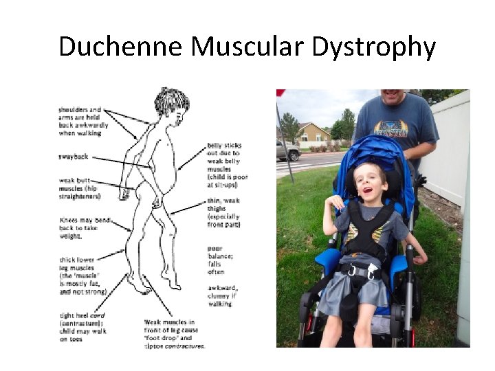 Duchenne Muscular Dystrophy 