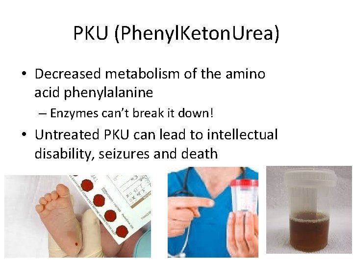 PKU (Phenyl. Keton. Urea) • Decreased metabolism of the amino acid phenylalanine – Enzymes