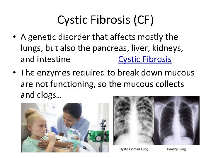 Cystic Fibrosis (CF) • A genetic disorder that affects mostly the lungs, but also