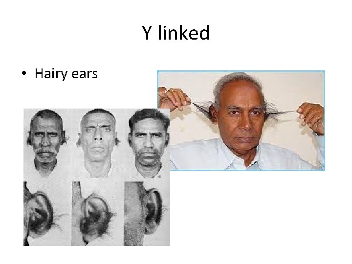 Y linked • Hairy ears 