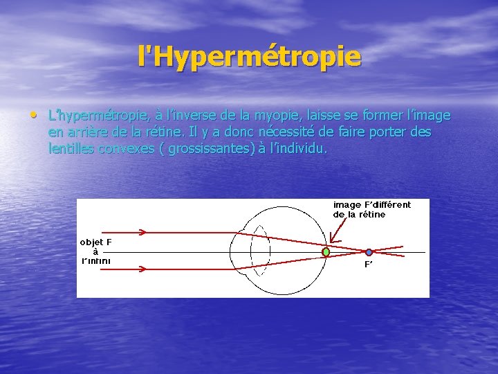 l'Hypermétropie • L’hypermétropie, à l’inverse de la myopie, laisse se former l’image en arrière
