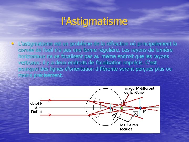 l'Astigmatisme • L'astigmatisme est un problème de la réfraction où principalement la cornée de