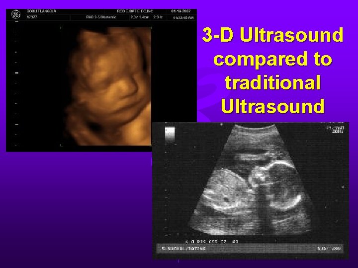 3 -D Ultrasound compared to traditional Ultrasound 3 -D Ultrasound compared to traditional Ultrasound
