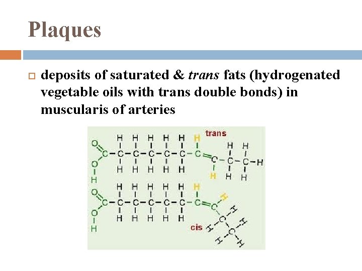 Plaques deposits of saturated & trans fats (hydrogenated vegetable oils with trans double bonds)