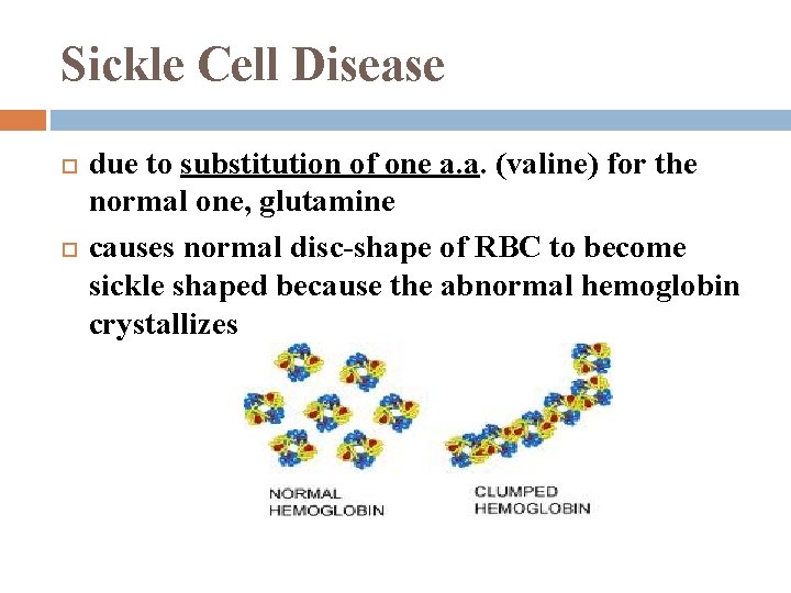 Sickle Cell Disease due to substitution of one a. a. (valine) for the normal