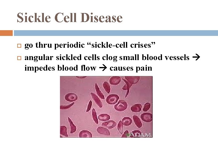 Sickle Cell Disease go thru periodic “sickle-cell crises” angular sickled cells clog small blood