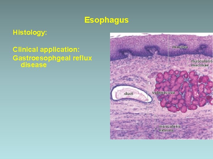 Esophagus Histology: Clinical application: Gastroesophgeal reflux disease 