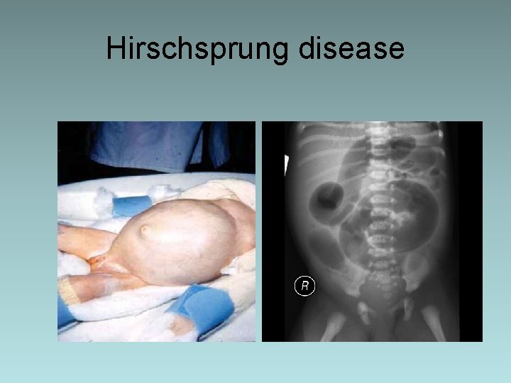 Hirschsprung disease 
