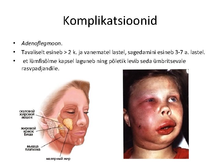 Komplikatsioonid • Adenoflegmoon. • Tavaliselt esineb > 2 k. ja vanematel lastel, sagedamini esineb