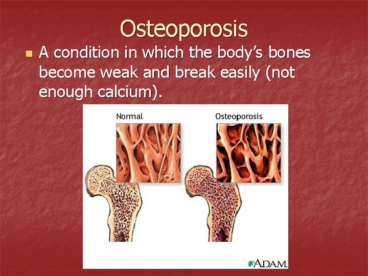 Osteoporosis n A condition in which the body’s bones become weak and break easily