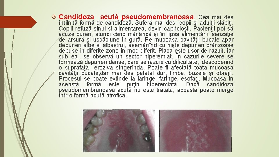  Candidoza acută pseudomembranoasa. Cea mai des întîlnită formă de candidoză. Suferă mai des