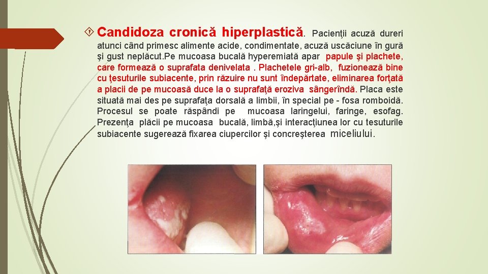  Candidoza cronică hiperplastică. Pacienţii acuză dureri atunci când primesc alimente acide, condimentate, acuză