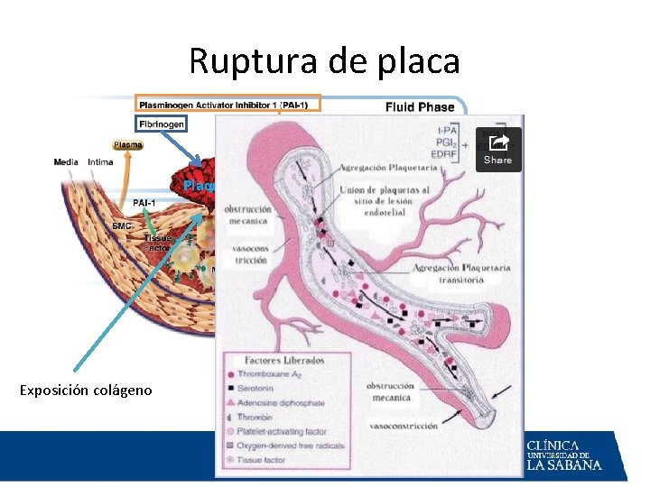SINDROME CORONARIO AGUDO IAM CON ELEVACION ST WILSON