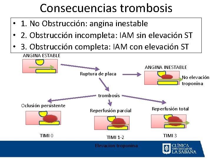 Consecuencias trombosis • 1. No Obstrucción: angina inestable • 2. Obstrucción incompleta: IAM sin Consecuencias trombosis • 1. No Obstrucción: angina inestable • 2. Obstrucción incompleta: IAM sin