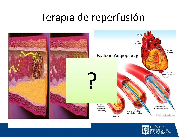 Terapia de reperfusión ? VS Terapia de reperfusión ? VS