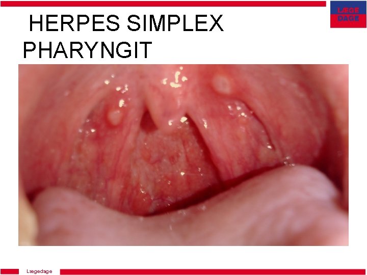 Udslæt herpes Herpes Genitalis