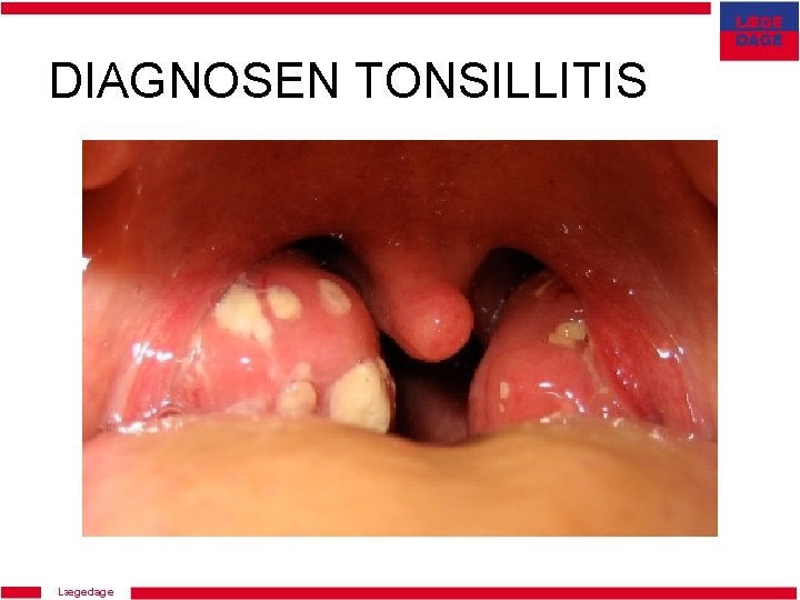 DIAGNOSEN TONSILLITIS Lægedage 