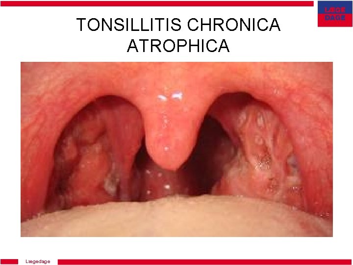 TONSILLITIS CHRONICA ATROPHICA Lægedage 
