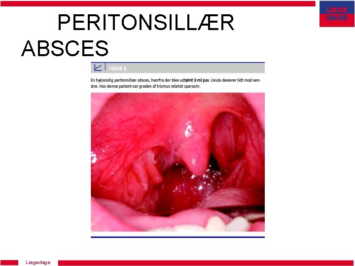 PERITONSILLÆR ABSCES Lægedage 