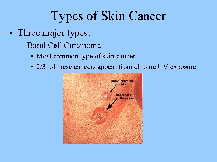 Types of Skin Cancer • Three major types: – Basal Cell Carcinoma • Most