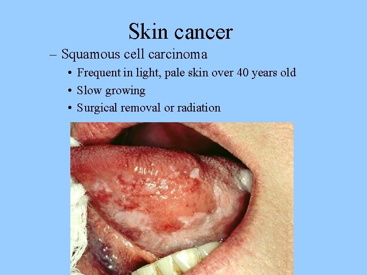 Skin cancer – Squamous cell carcinoma • Frequent in light, pale skin over 40